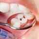 علت سوراخ شدگی دندان چیست و روش‌های ترمیم سوراخ دندان کدام است؟